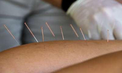 dry needling in leg close up
