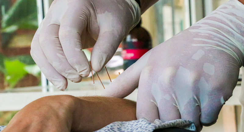 dry needling inserting into arm